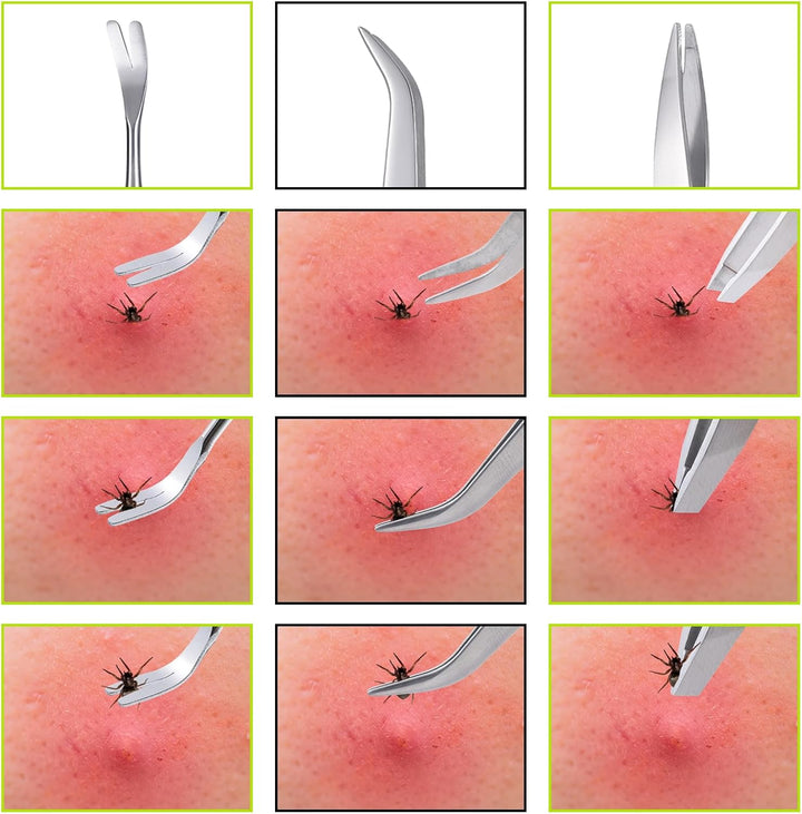 3 in 1 Tick Remover Kit, 3 Pack Stainless Steel Tick Tweezers, Ticks Fork and Portable Storage Case for Cats and Dogs